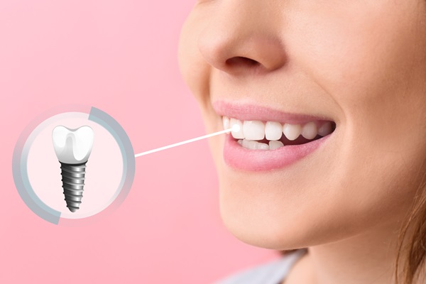 How To Properly Care For Dental Implants