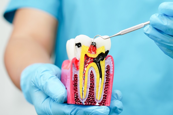 Three Signs You May Need A Root Canal